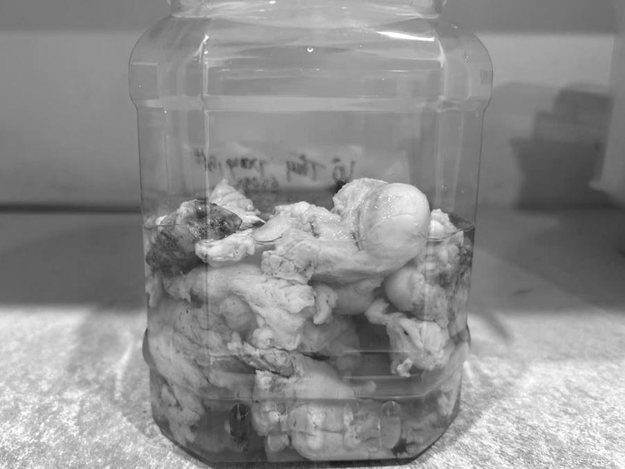 Khối nhân xơ tử cung nặng 650 gram được các bác sĩ lấy ra thành công bằng phương pháp phẫu thuật nội soi.