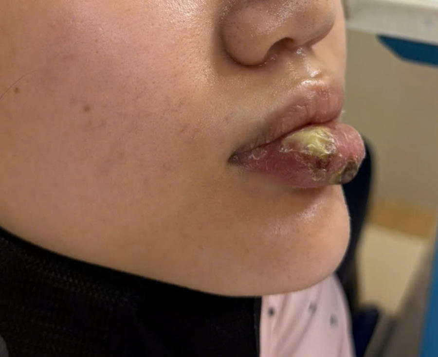 Hình ảnh môi bị nhiễm trùng sau khi sau tiêm “giải filler” tại cơ sở không phép. (Ảnh: Bệnh viện Bạch Mai)