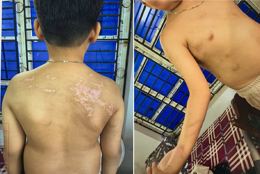 Hình ảnh thương tích của cháu N. Đ. B. K. sau khi bị Nguyễn Hà Chung đánh gây thương tích.