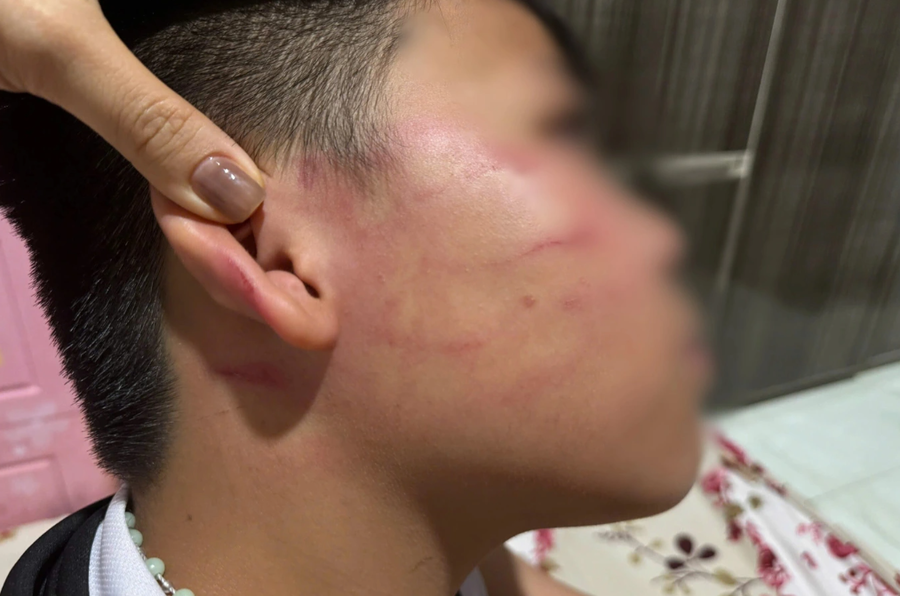 Trên vùng má, tai cháu V. xuất hiện nhiều vết bầm đỏ nghi do bị giáo viên dạy thêm tiếng Anh tát vào mặt. Ảnh: Gia đình cung cấp.