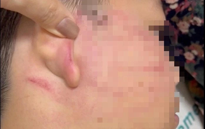 Học sinh lớp 4 bị thầy giáo Ấn Độ tát thủng màng nhĩ.