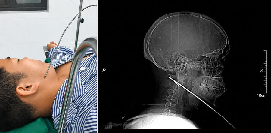 Các bác sĩ tại Bệnh viện Đa khoa khu vực Bắc Quang đã phẫu thuật thành công ca tai nạn mũi tên bắn cá hy hữu. (Ảnh: BTQ).