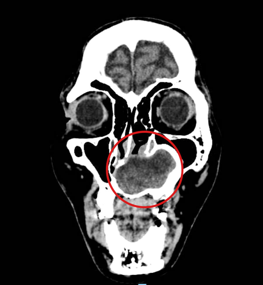 Hình ảnh MRI cho thấy khối u nang xương hàm kích thước khoảng 4 × 5 cm.