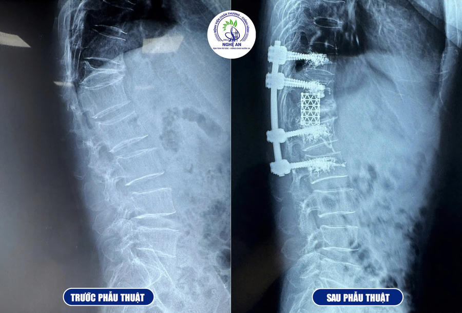 Hình ảnh đốt sống của bệnh nhân P.N.K. trước và sau phẫu thuật.