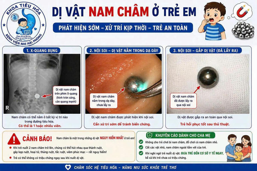 Bệnh viện Nhi Hải Phòng nội soi gắp dị vật thành công cho bệnh nhi 38 tháng tuổi nuốt phải viên bi nam châm - Ảnh: Bệnh viện Cung cấp