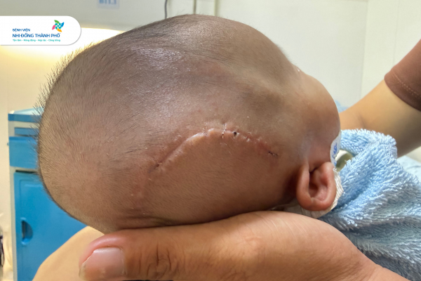 Cháu bé phục hồi ngoạn mục sau phẫu thuật. (Ảnh: Bệnh viện Nhi Đồng Thành Phố)